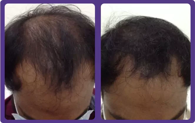 GFC Hair Treatment Before & After