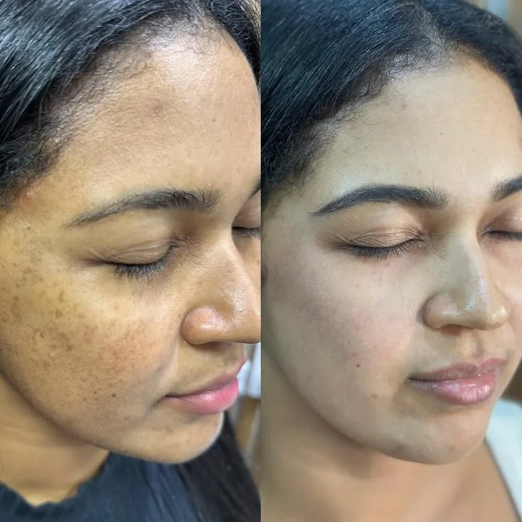Glutathione Before & After