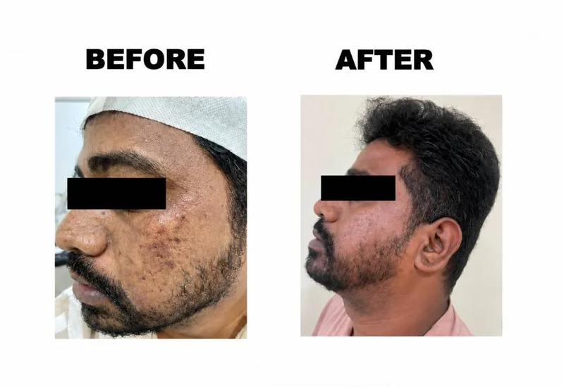 MNRF acne scar treatment before and after