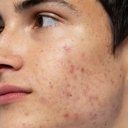 Acne, Acne Pigmentation, and Acne Scar Treatment