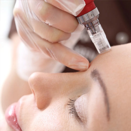 Microneedling