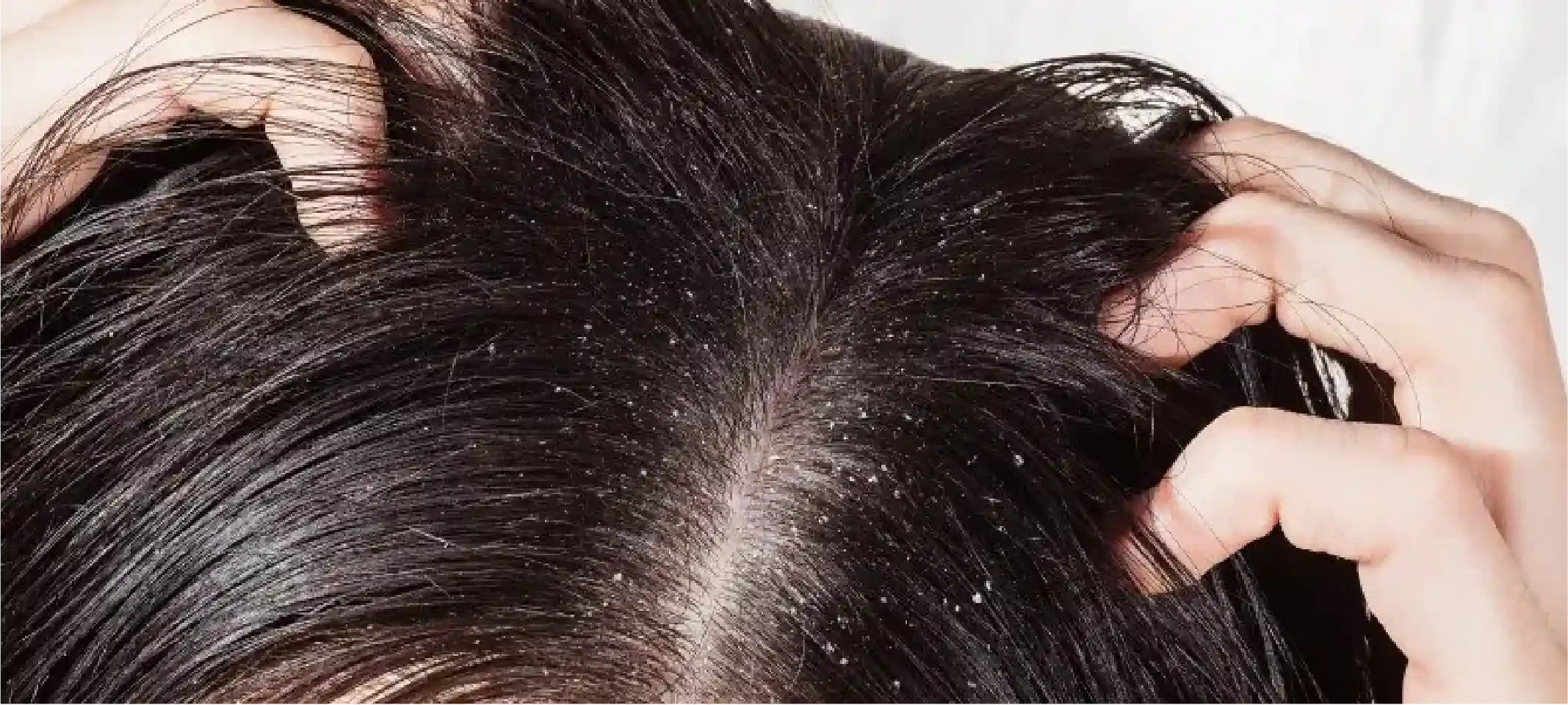Dandruff Treatment