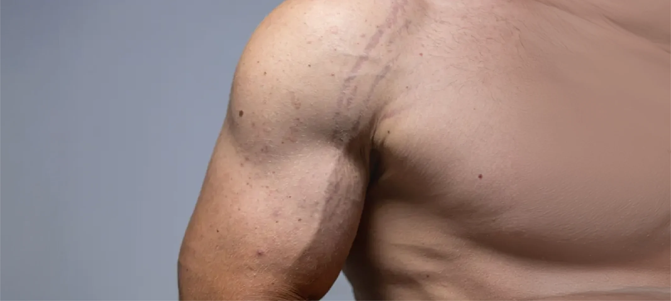 Stretch Marks Removal