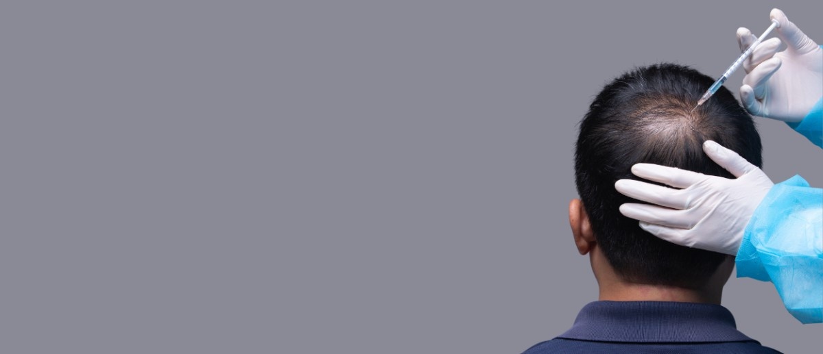 PRP Hair Treatment in T Nagar Chennai