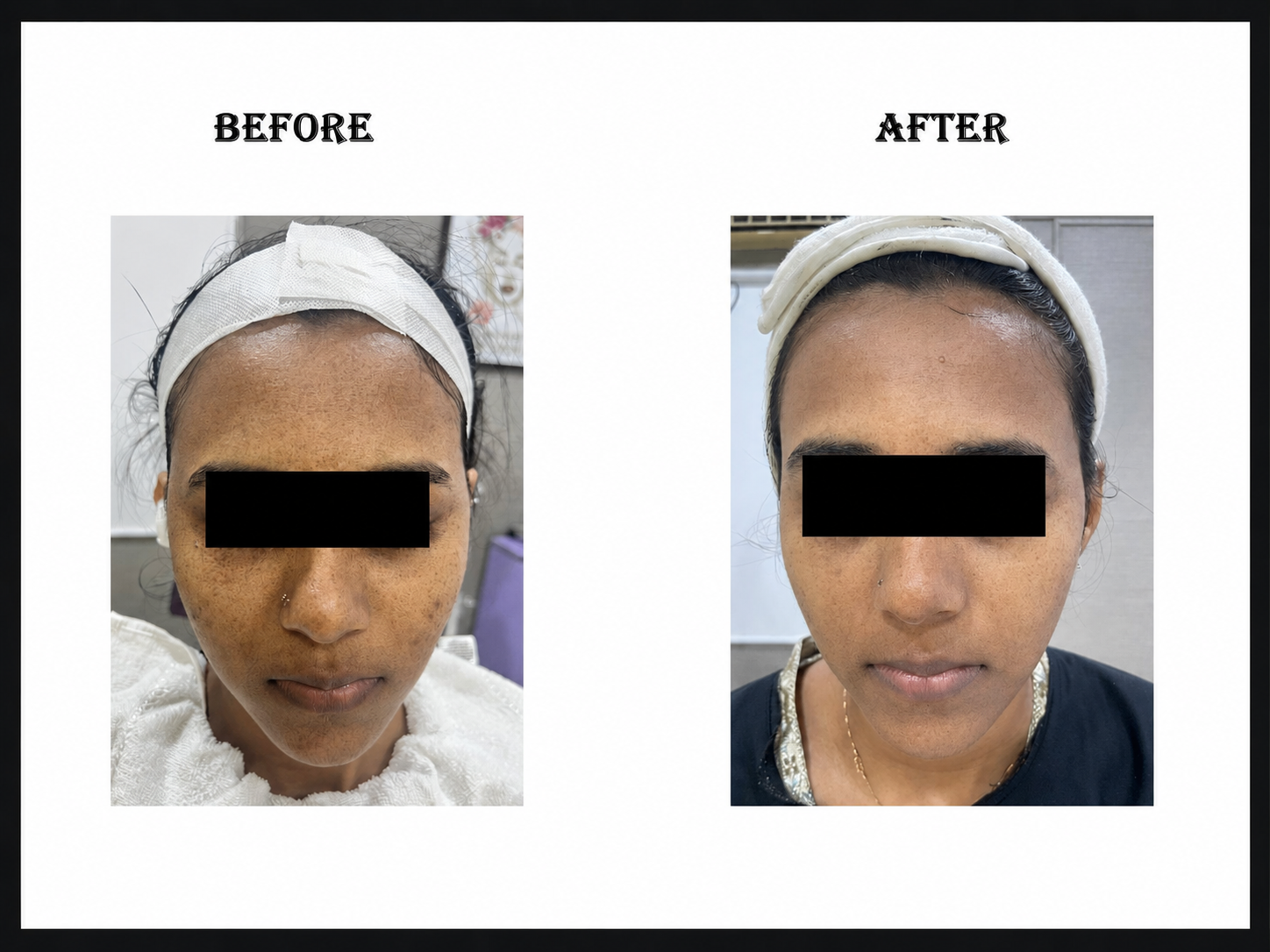 Blutoning for Pigmentation