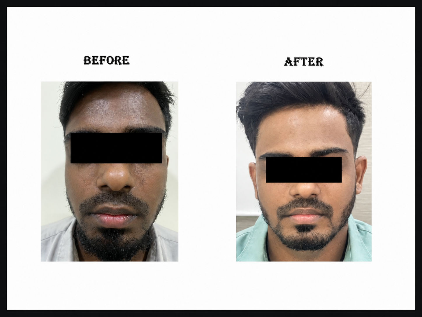 Anti pigment peel + bluetoning