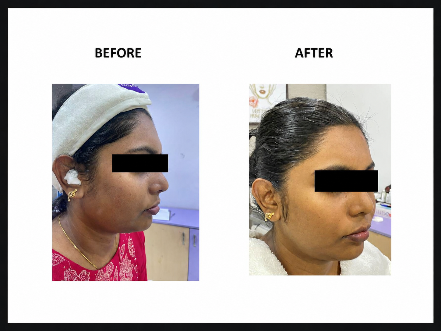 Anti pigmentation peel