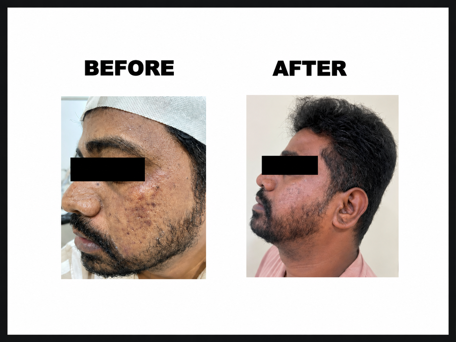 MNRF for acne scar