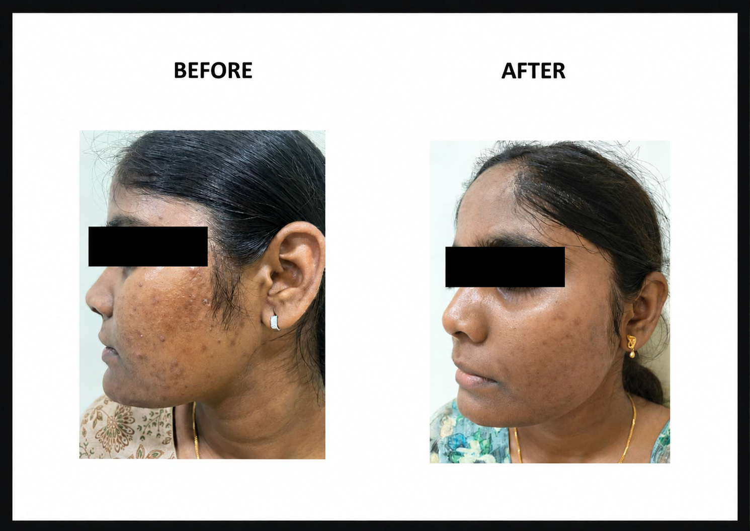 Acne control peel