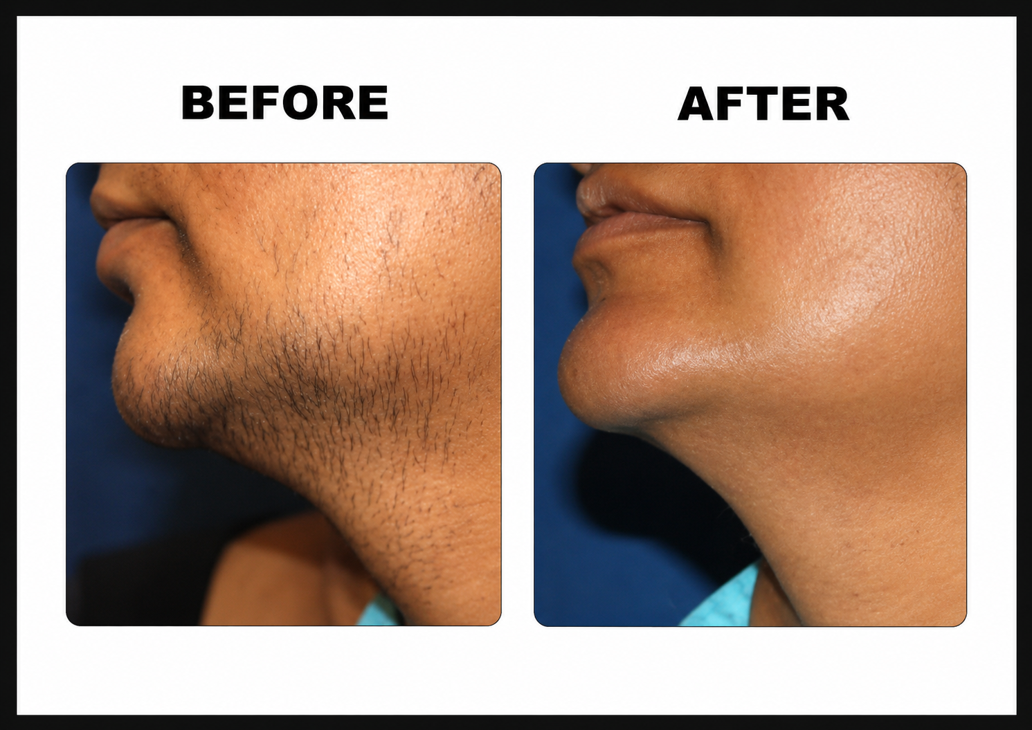 Permanent laser hair removal