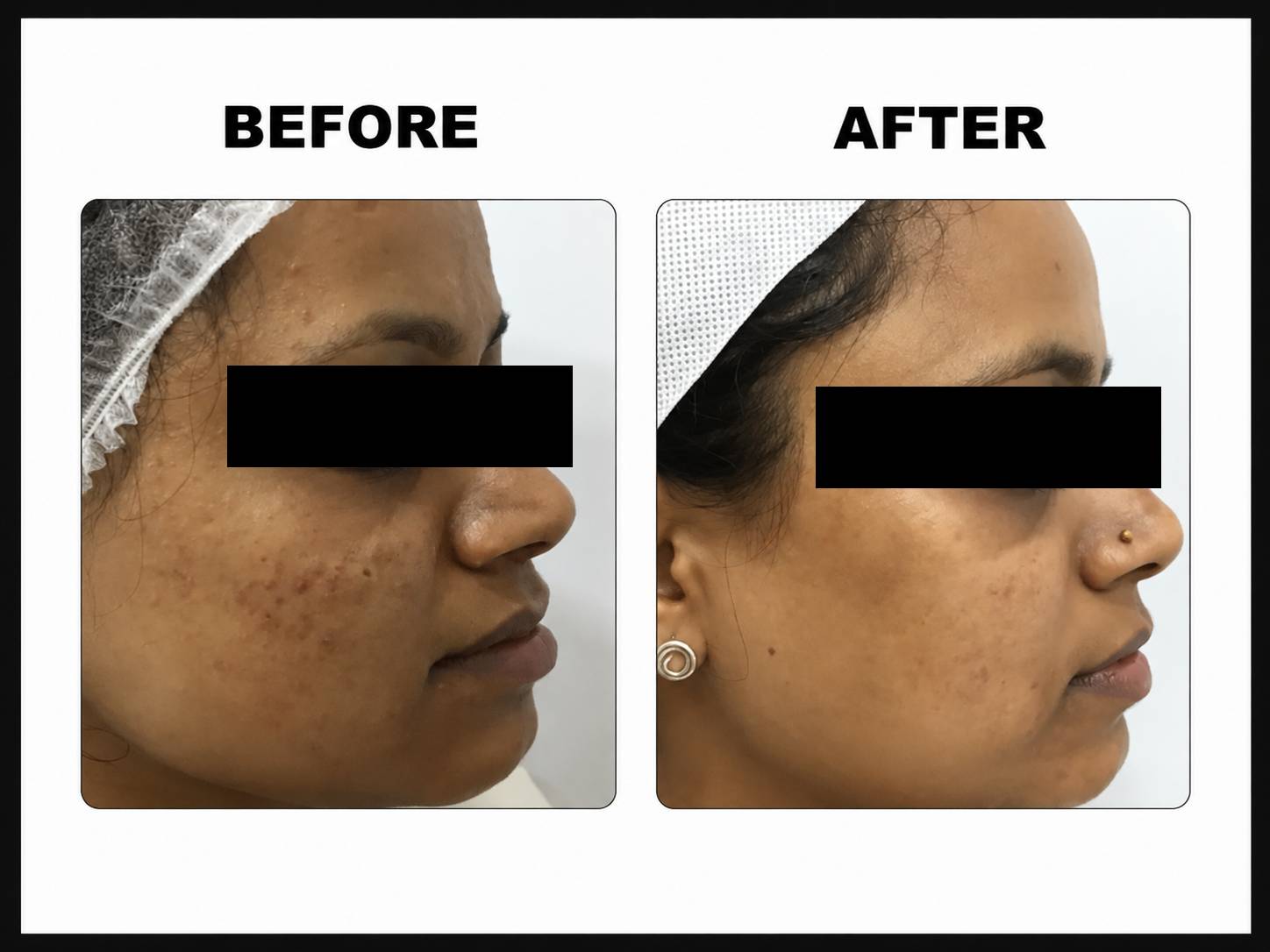 Acne scar Treatment