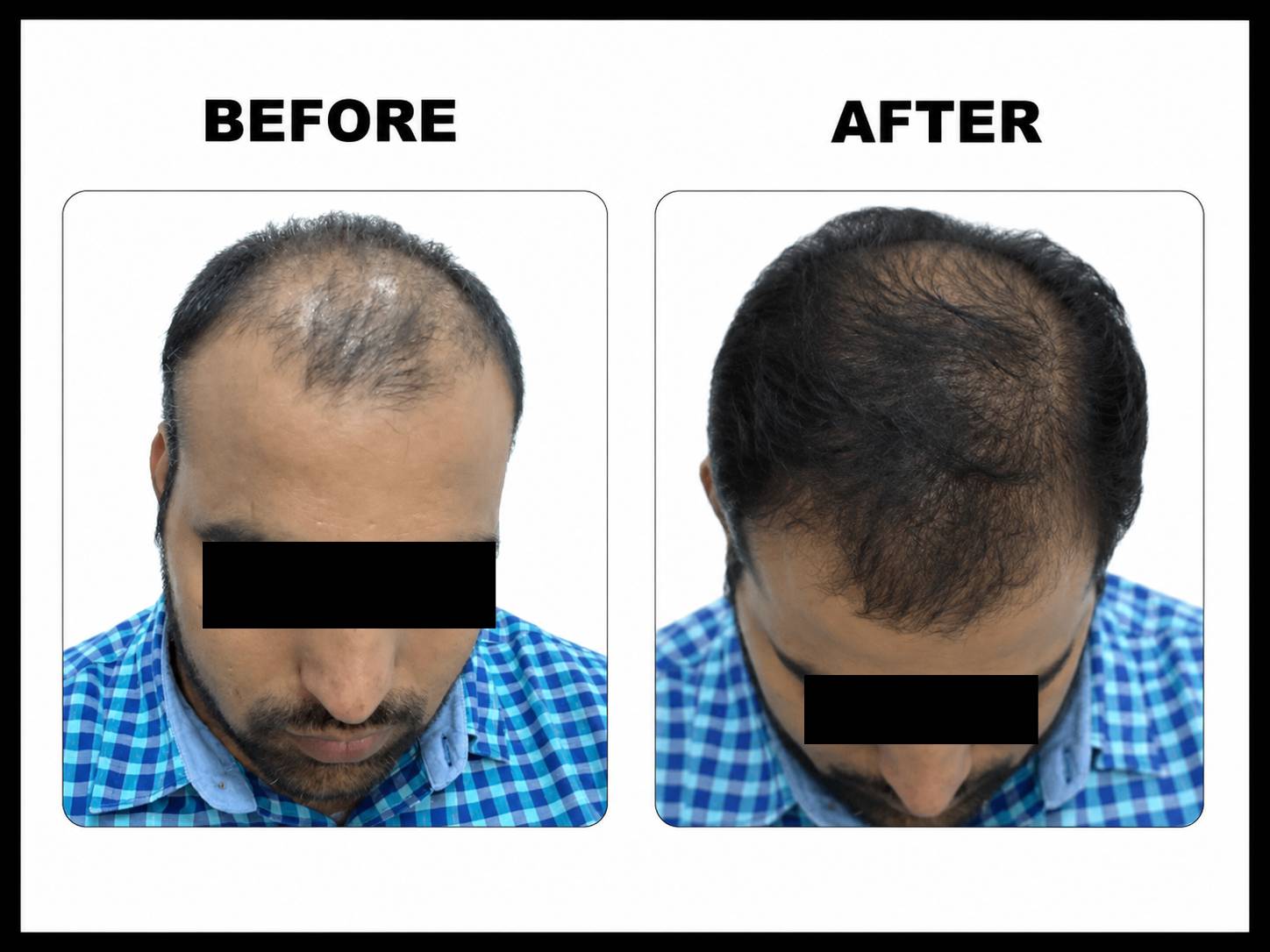 GFC+ Microneedling
