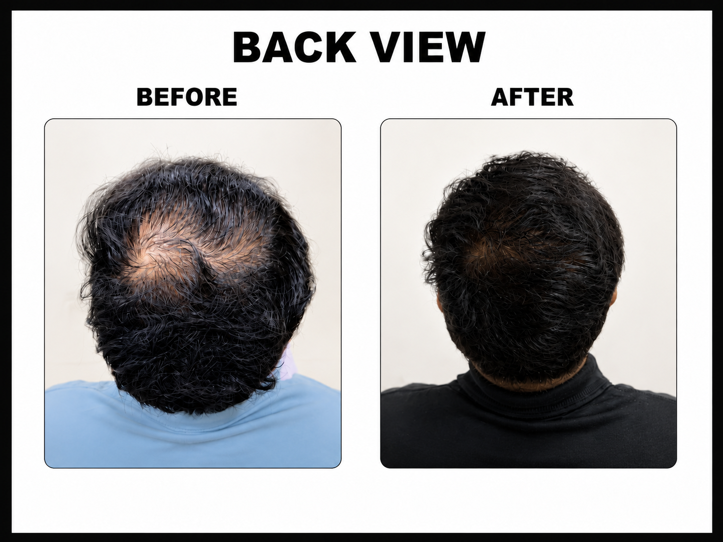GFC for Hair Growth